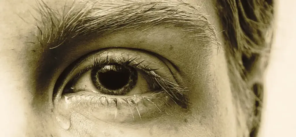 Alcoholic Jaundice Eyes